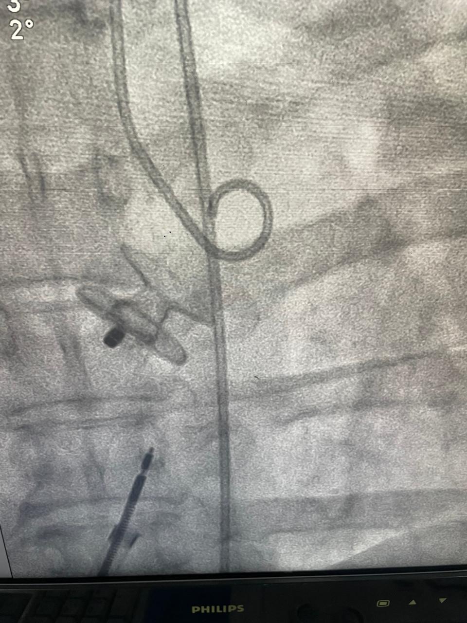 Atrial Flow Regulator Procedure Photo 3