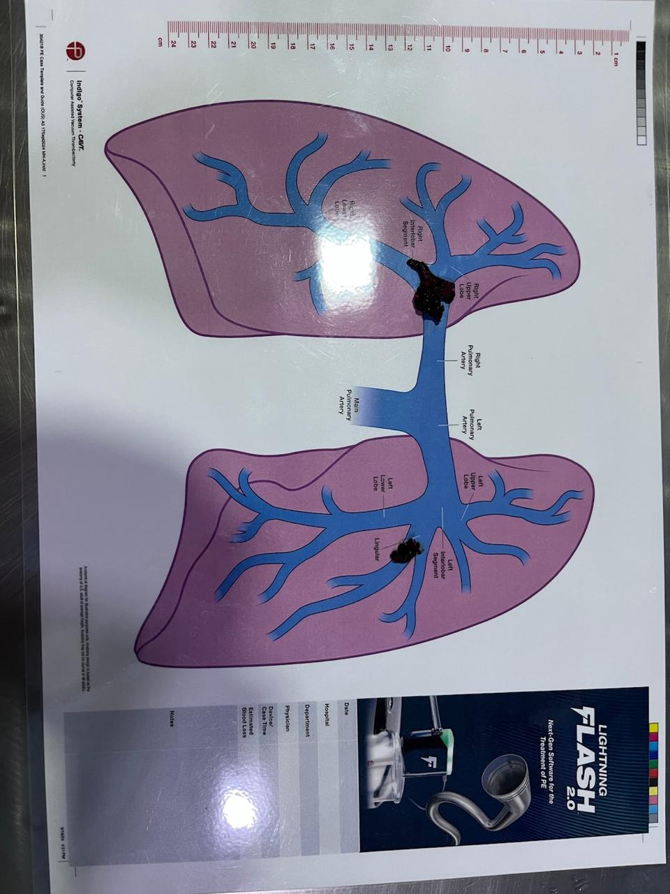 Pulmonary Thrombectomy Image 1